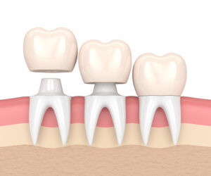 Illustration of dental crowns from For You Dental in Dallas, TX